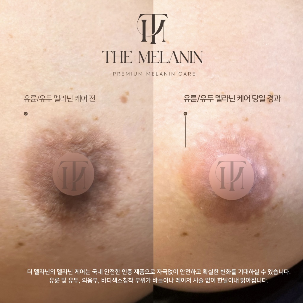 乳輪ケア Before After