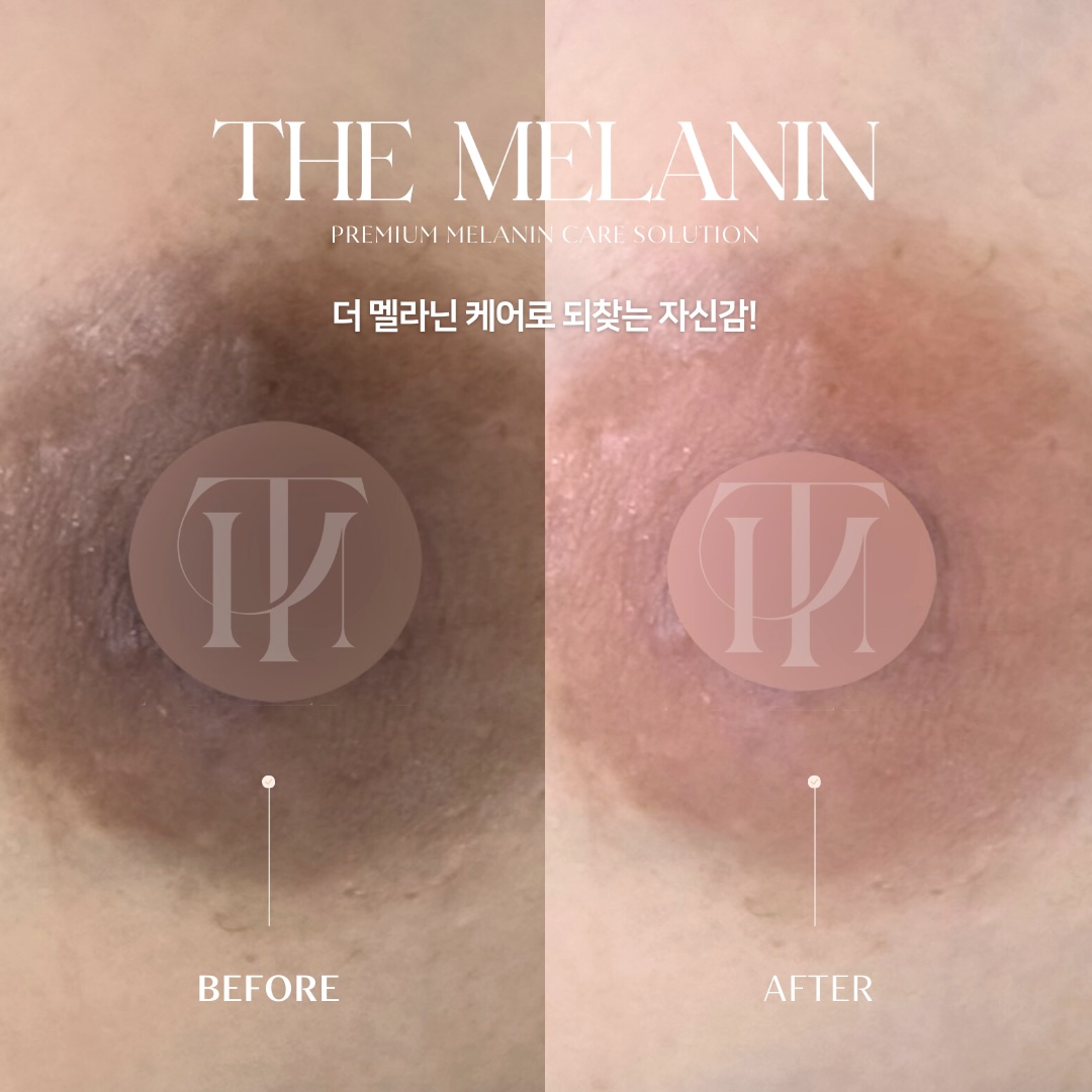 乳輪ケア Before After