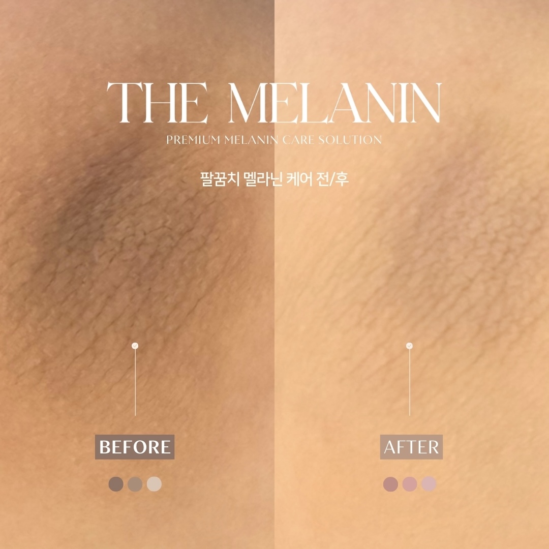 肘ケア Before After