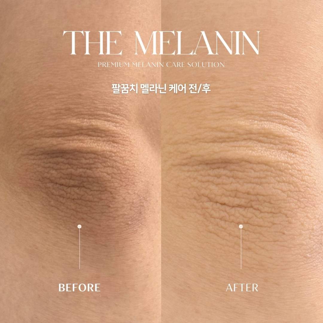 肘ケア Before After