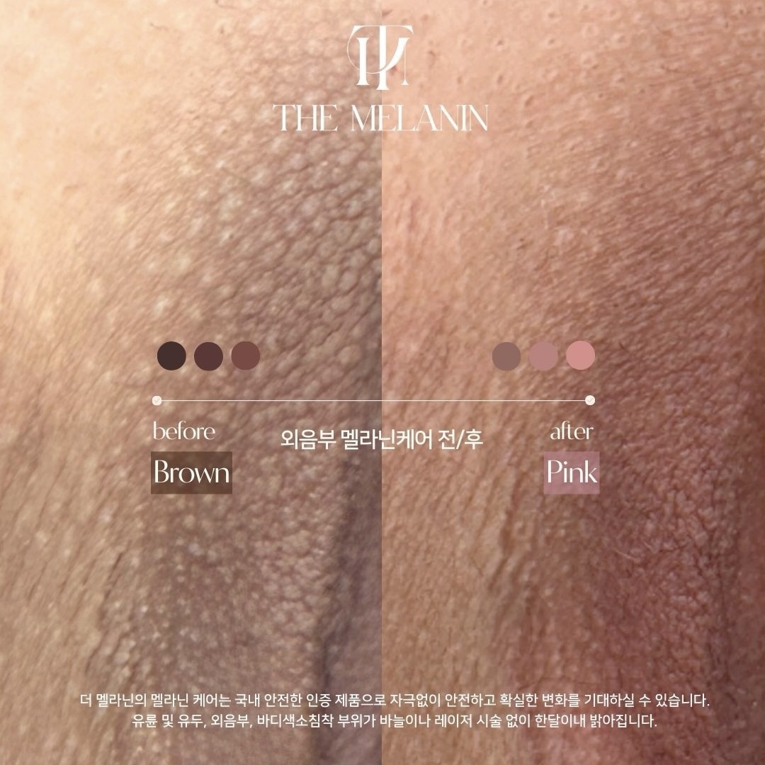 Iラインケア Before After