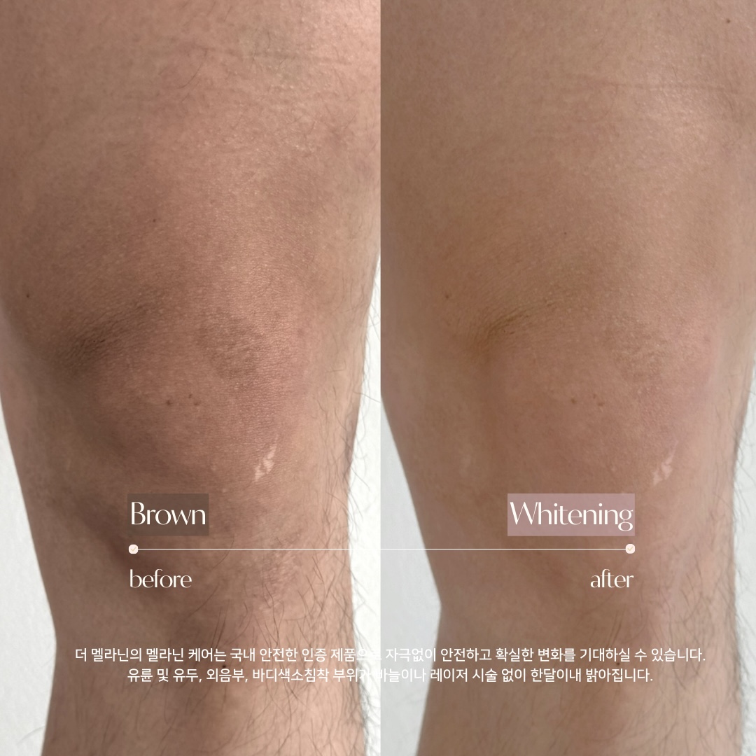 膝ケア Before After