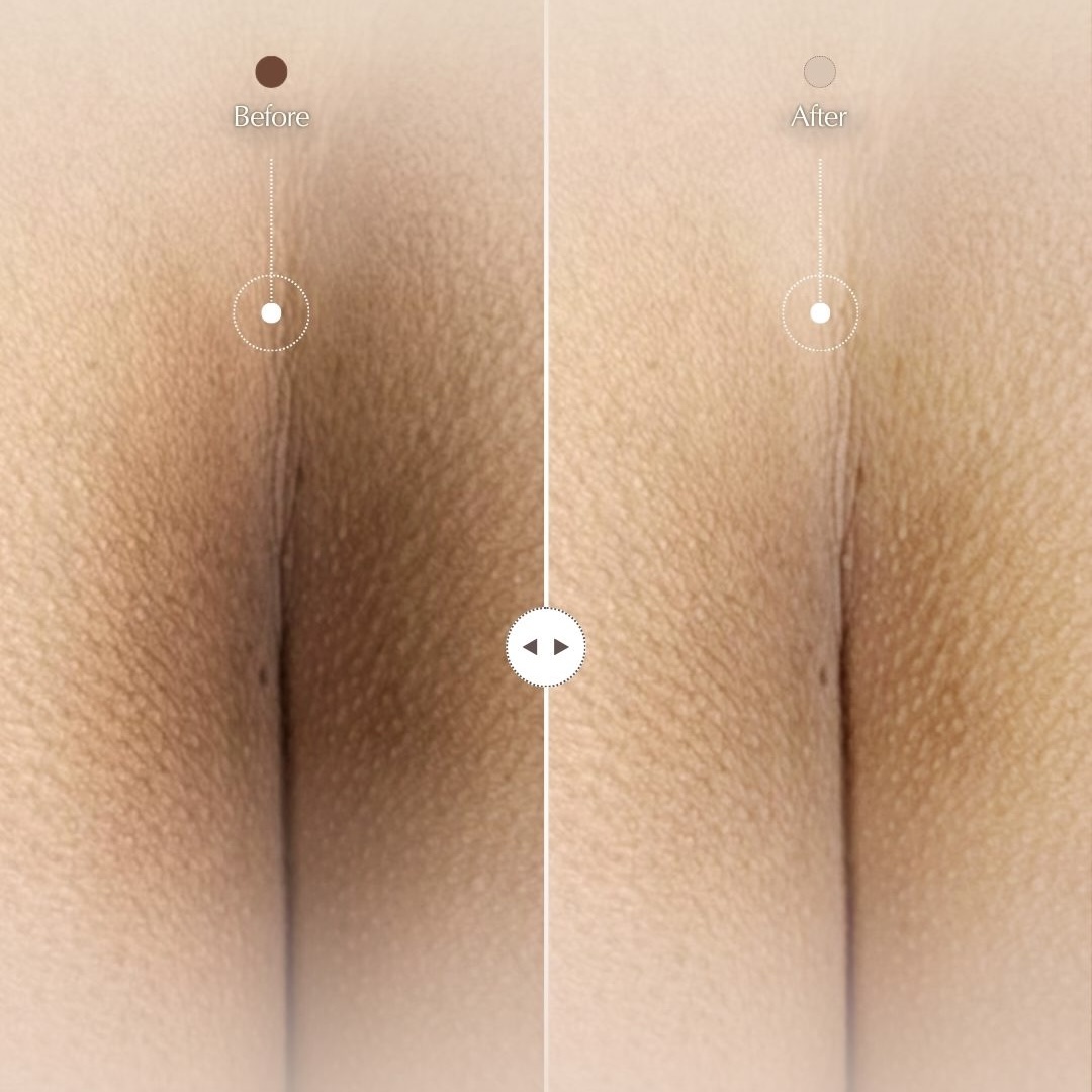 Oラインケア Before After